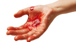 Blutung stoppen: Maßnahmen, um eine leichte bis starke Blutung aufzuhalten